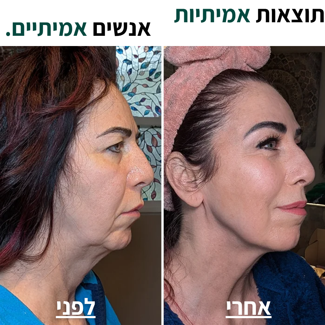 מכשיר לחיזוק ומיצוק עור הפנים מבית MOR-VEN