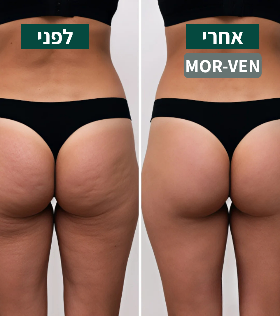 מכשיר עיסוי נגד צלוליט